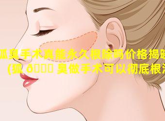 狐臭手术真能永久根除吗价格揭晓(狐 🍀 臭做手术可以彻底根治吗要花 🐧 多少钱)